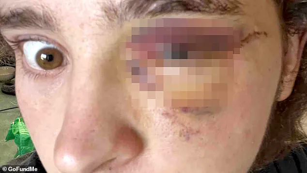 Alleged ICE Projectile Strike Leaves College Student at Risk of Permanent Vision Loss, Sparking Concerns Over Protester Safety