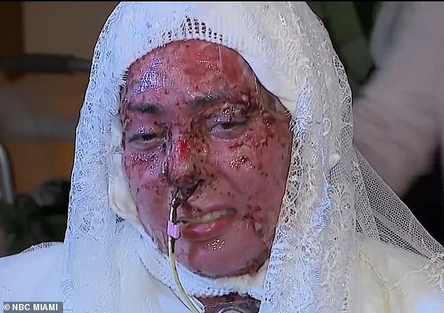 Survivor of Grill Explosion Ties the Knot in Hospital Chapel, Sparking Safety Debates