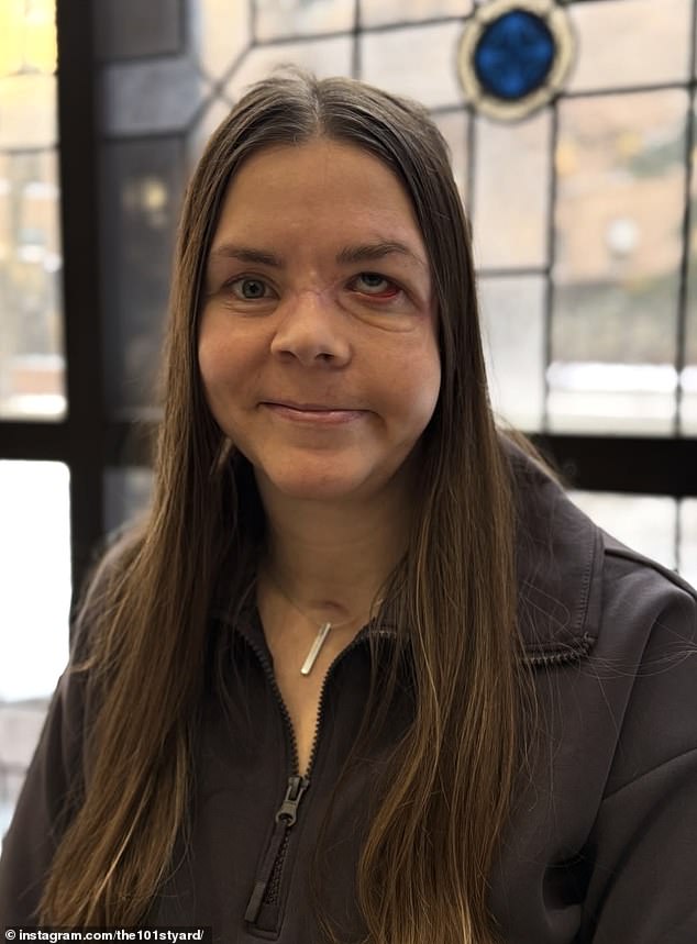 Alaska Mother Reveals Severe Injuries After Being Dragged 100 Yards by Bear