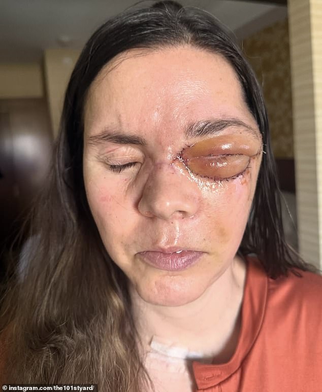 Alaska Mother Reveals Severe Injuries After Being Dragged 100 Yards by Bear