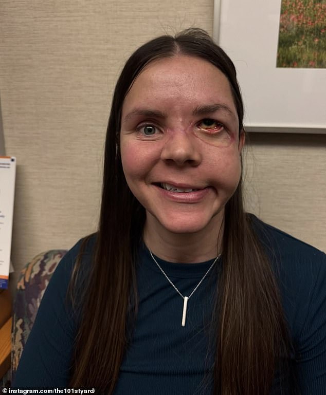 Alaska Mother Reveals Severe Injuries After Being Dragged 100 Yards by Bear