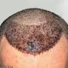 Dallas Surgeon Issues Stark Warning on Risks of Cheap Hair Transplants, Highlighting Catastrophic Outcomes from Turkey Clinics