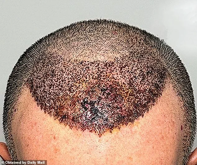 Dallas Surgeon Issues Stark Warning on Risks of Cheap Hair Transplants, Highlighting Catastrophic Outcomes from Turkey Clinics
